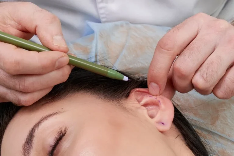 Otoplasti