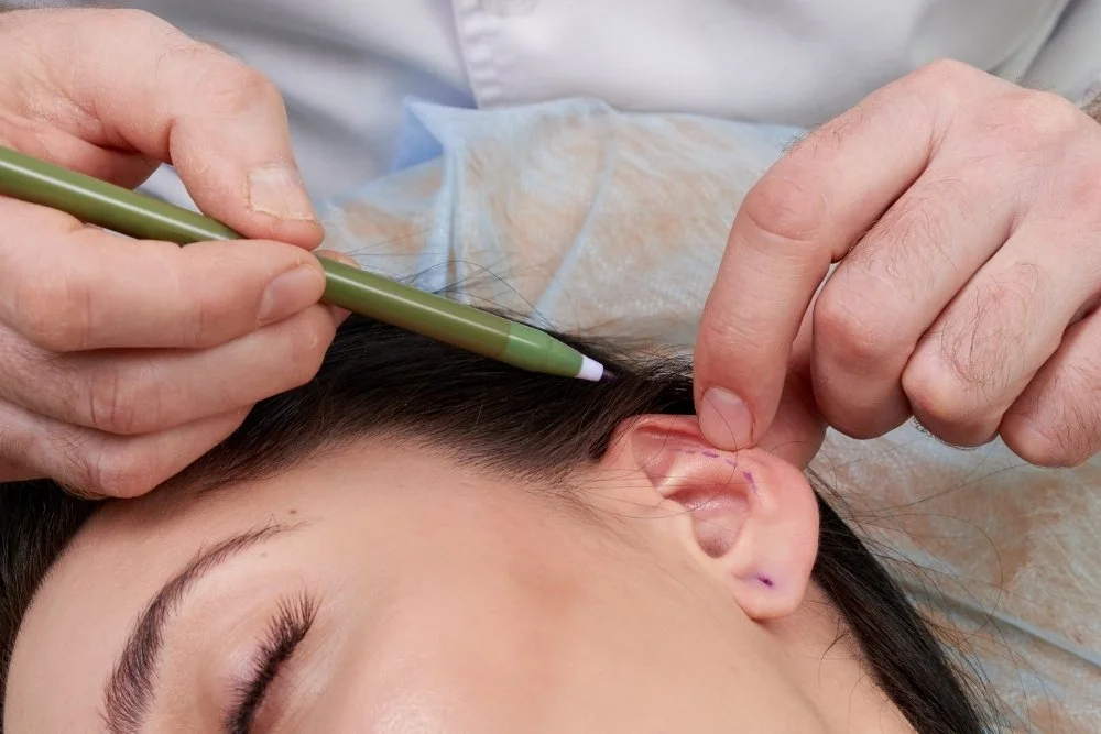 Otoplasti